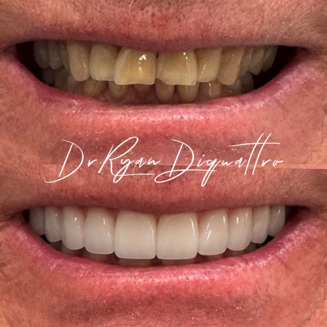 Before and after cosmetic dentistry case — DiQuattro Advanced Dentistry