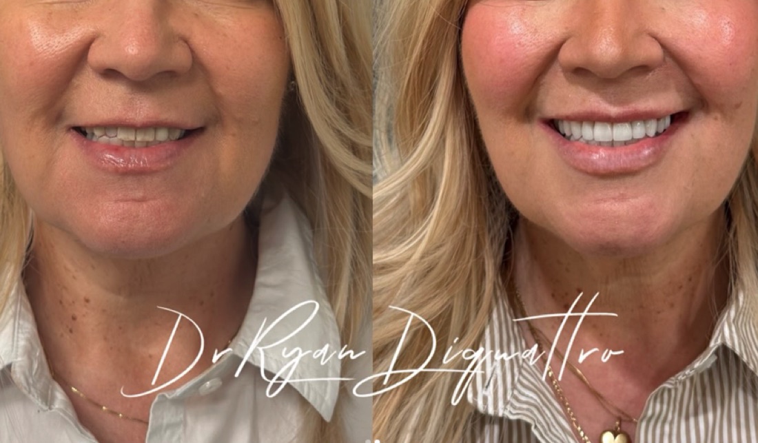 Veneers before and after — Dr. Ryan DiQuattro