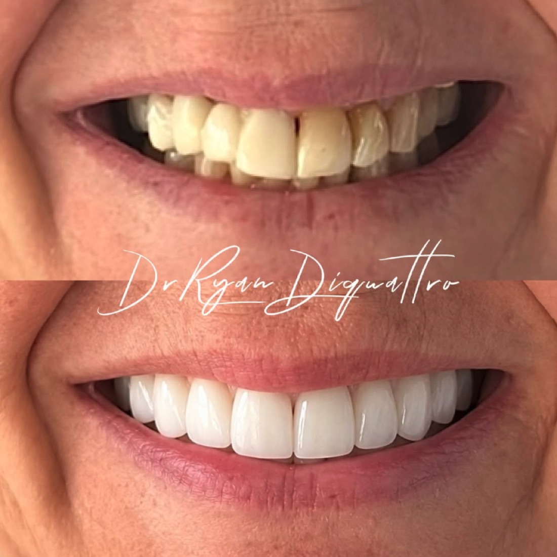 Porcelain veneers case — Scottsdale cosmetic dentist