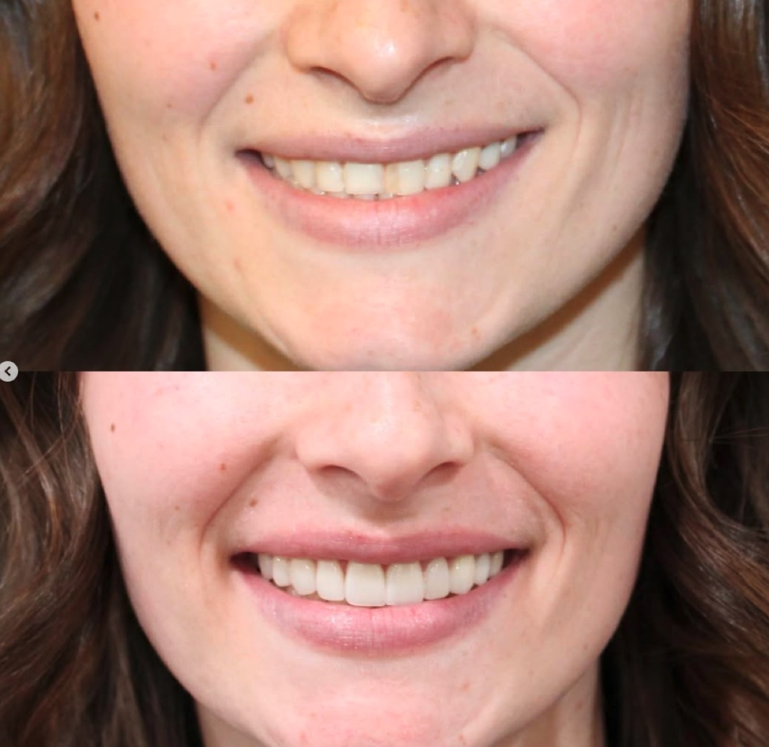 Before and after smile — cosmetic dentistry