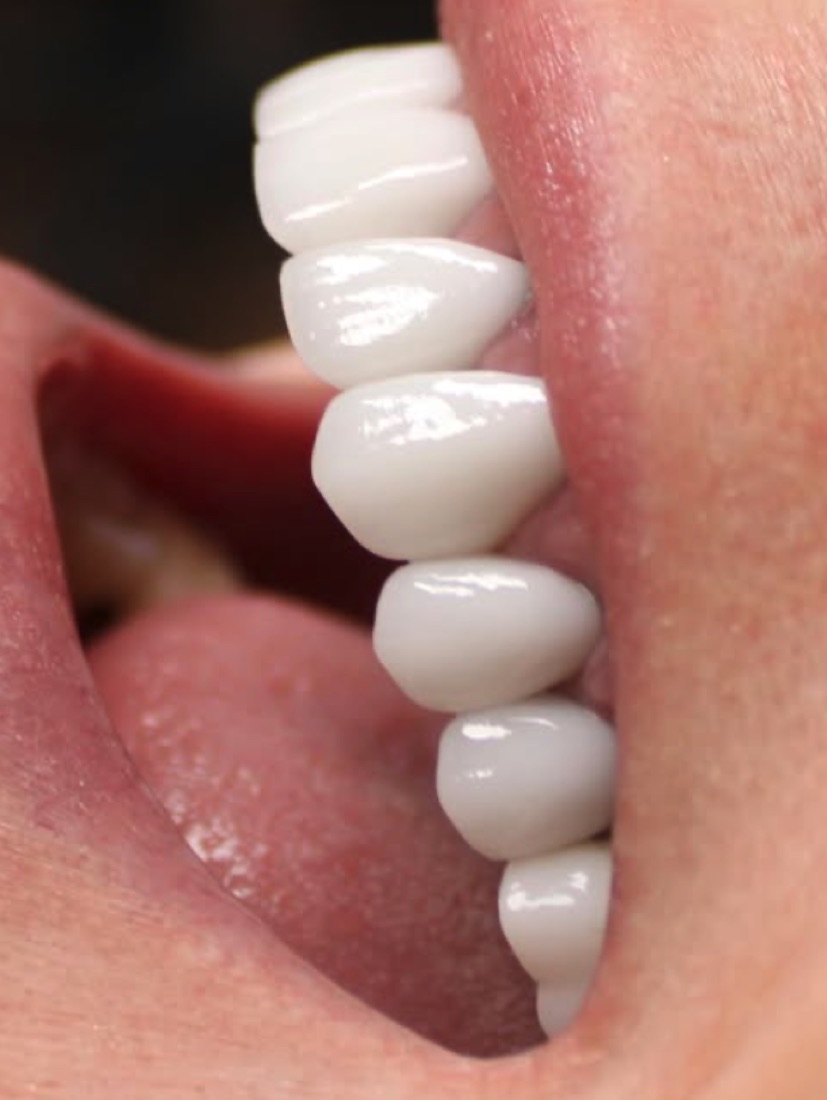 Porcelain veneers close-up — Dr. Ryan DiQuattro