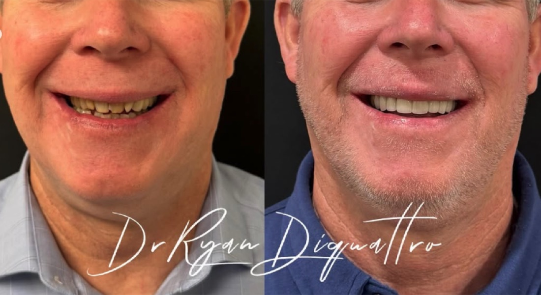 Smile transformation before and after — Scottsdale