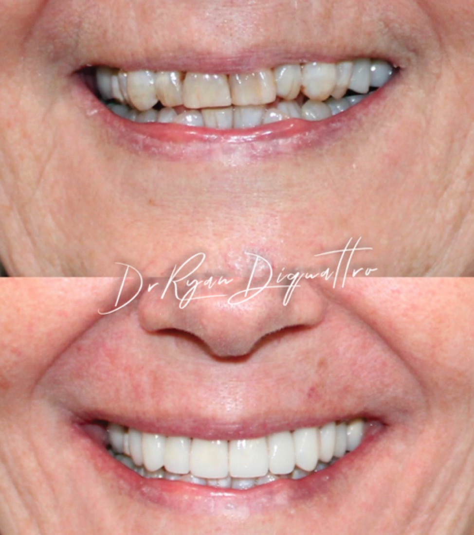 Cosmetic dentistry case — DiQuattro Advanced Dentistry