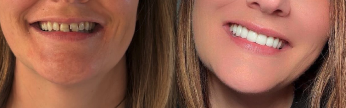 Before and after veneers — Scottsdale cosmetic dentist