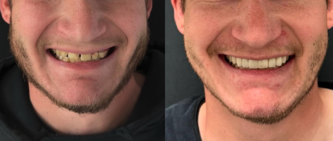 Smile makeover before and after