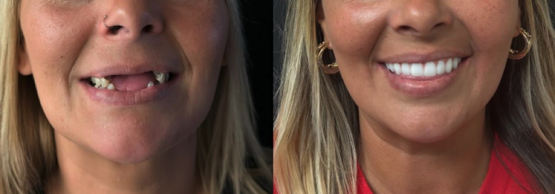 Cosmetic dentistry result — Dr. Ryan DiQuattro