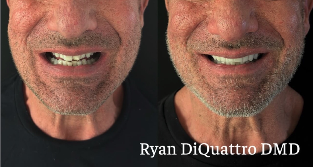 Before and after smile — DiQuattro Advanced Dentistry
