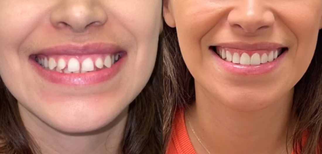 Veneers case — Scottsdale