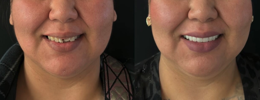 Smile transformation — cosmetic dentistry Scottsdale