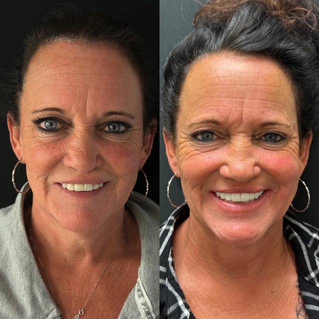Full-face smile makeover before and after — Dr. Ryan DiQuattro