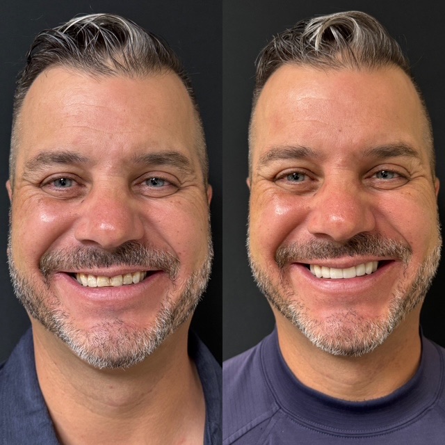 Smile makeover before and after — DiQuattro Advanced Dentistry