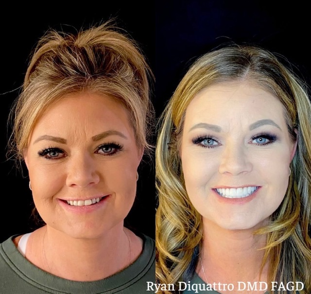Cosmetic dentistry before and after — Dr. Ryan DiQuattro