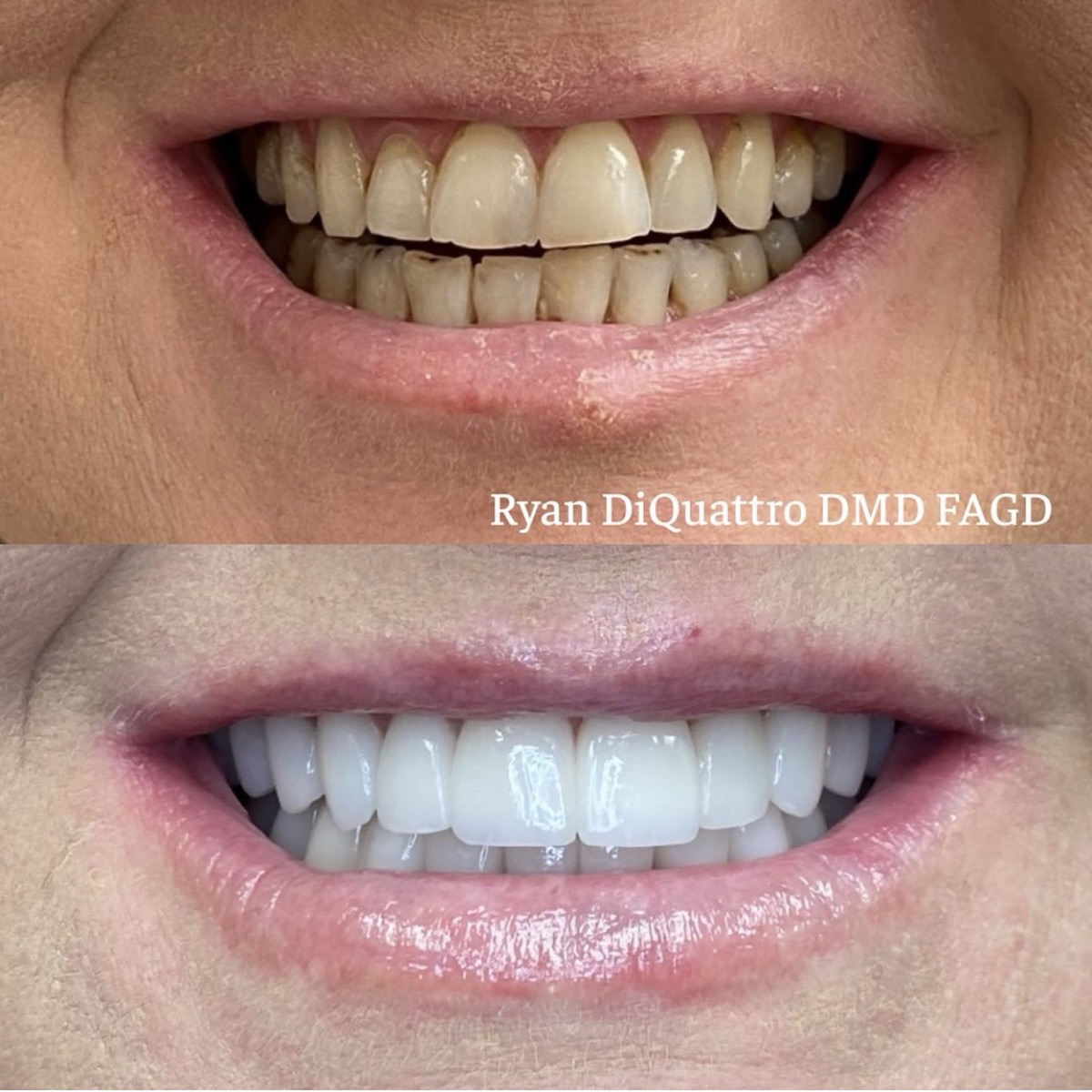 Porcelain veneers close-up before and after — Scottsdale