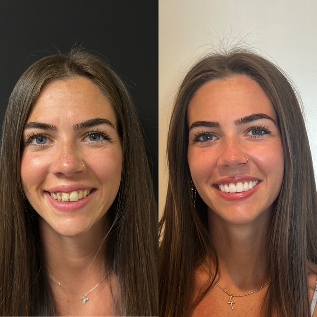 Smile makeover before and after — cosmetic dentistry Scottsdale