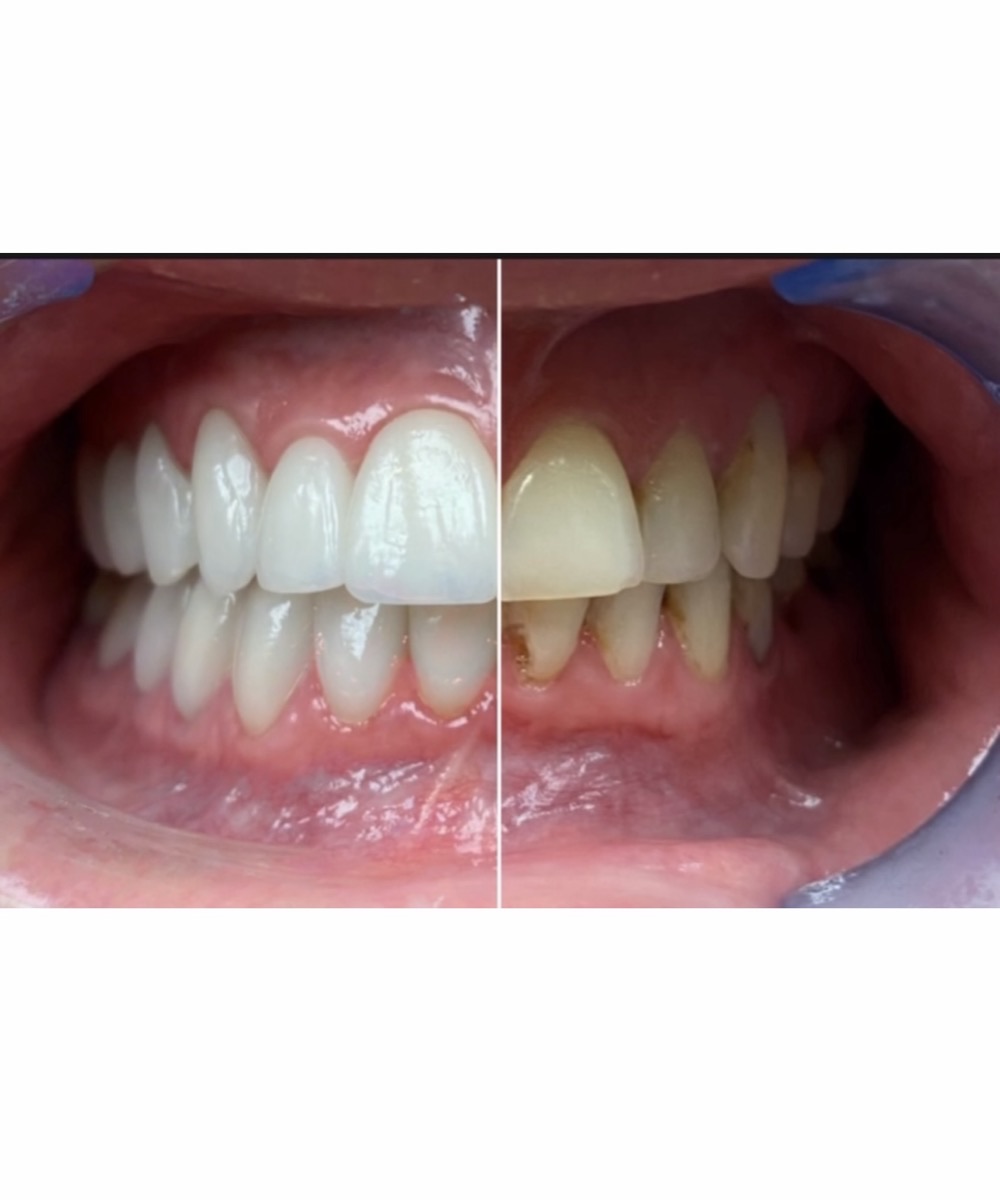 Porcelain veneers detail — Dr. Ryan DiQuattro