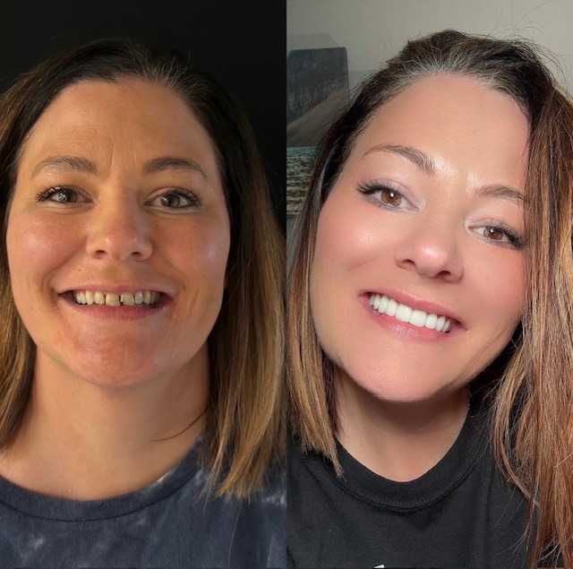 Smile transformation before and after — DiQuattro Advanced Dentistry