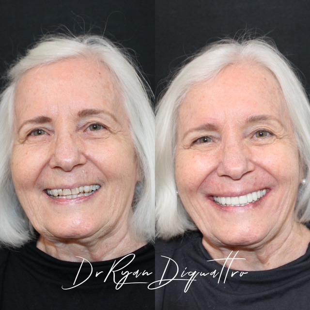 Full-face smile makeover before and after — Scottsdale cosmetic dentist