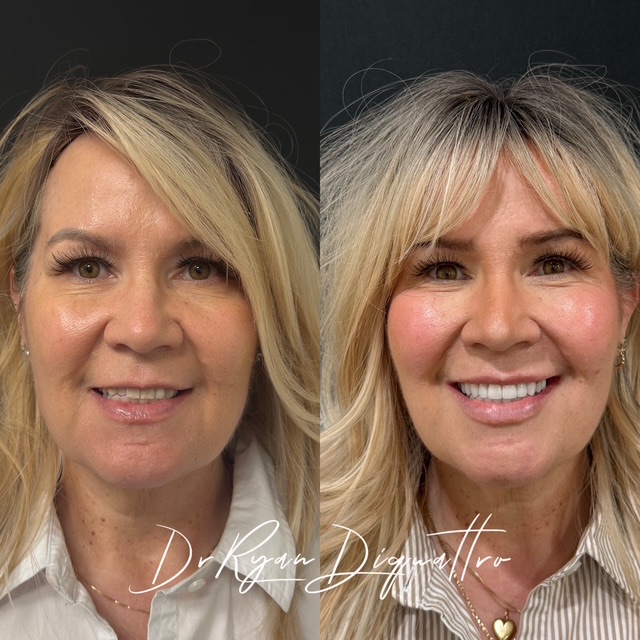 Cosmetic dentistry smile transformation before and after