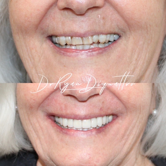 Veneers before and after close-up — Dr. Ryan DiQuattro
