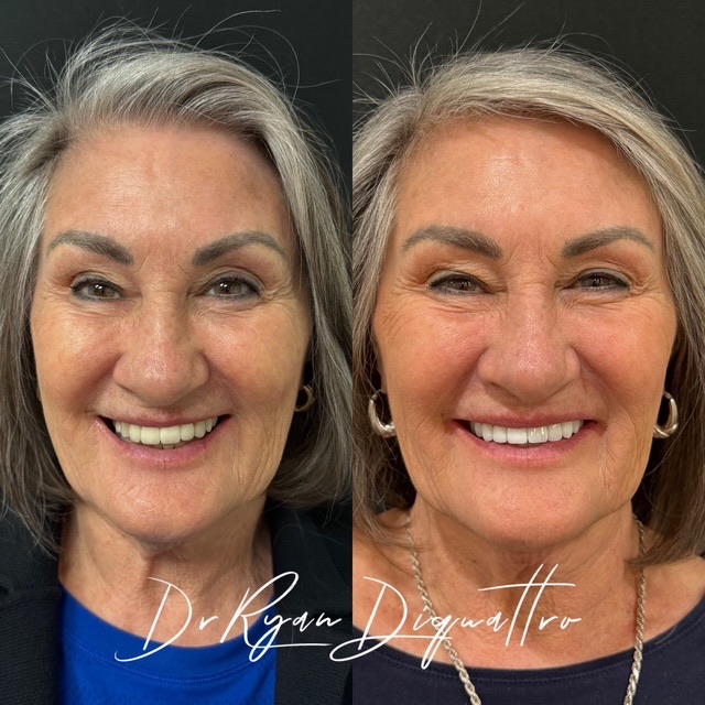 Smile makeover before and after — Scottsdale