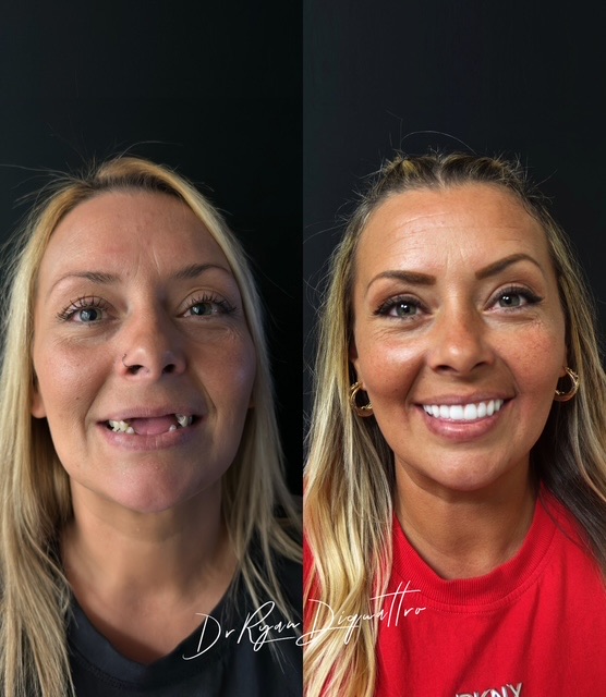 Full-mouth smile transformation before and after — DiQuattro Advanced Dentistry