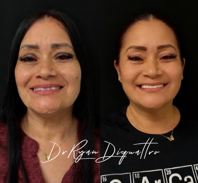 Smile makeover before and after — Dr. Ryan DiQuattro Scottsdale