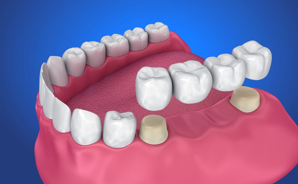 Tooth,Supported,Fixed,Bridge.,Medically,Accurate,3d,Illustration 1760462892 2196ba580a4d4b6eb75053a77c91b726 1