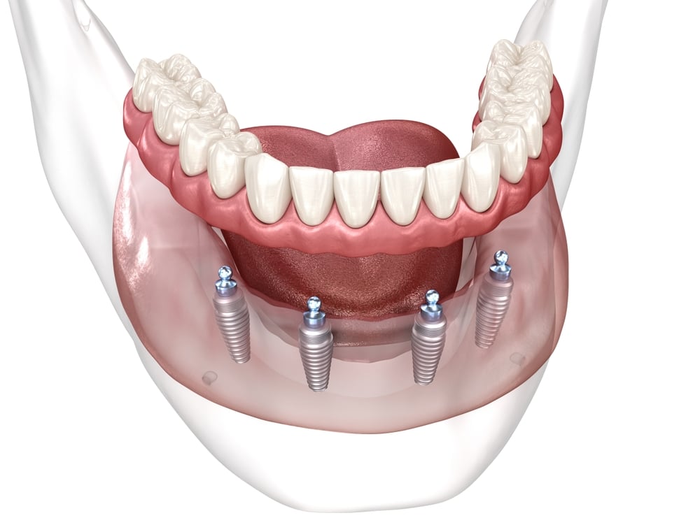 Dental,Prosthesis,Based,On,4,Implants.,Dental,3d,Illustration 1760462911 0306315d041640dc8b5421aeed16f899 1