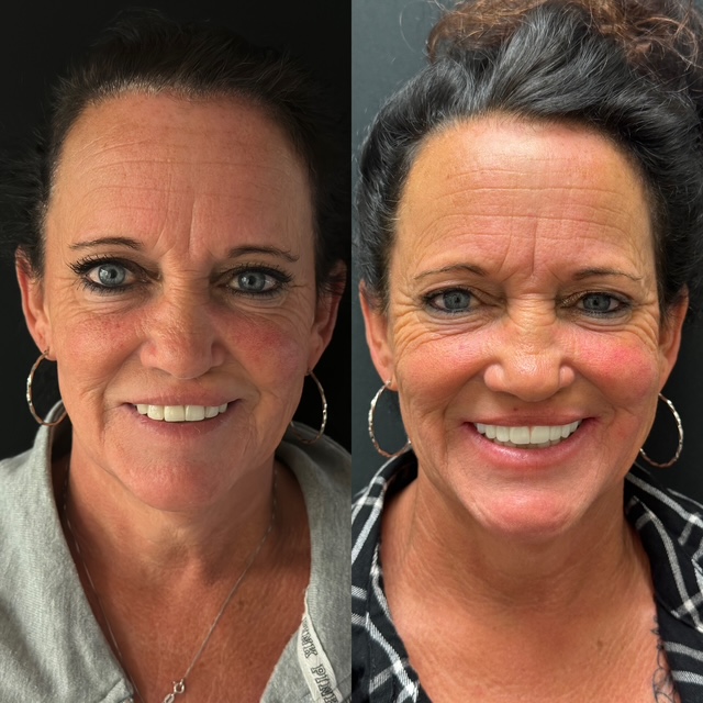 Before and After Image: Smile Makeover - front