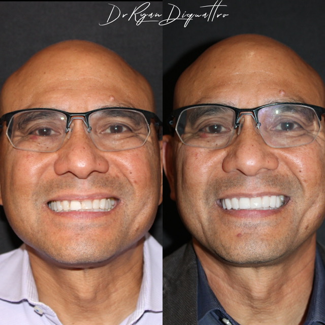Before and After Image: Smile Makeover - front