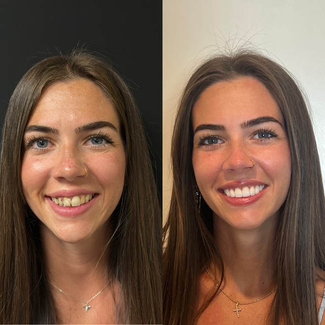 Before and After Image: Smile Makeover - front