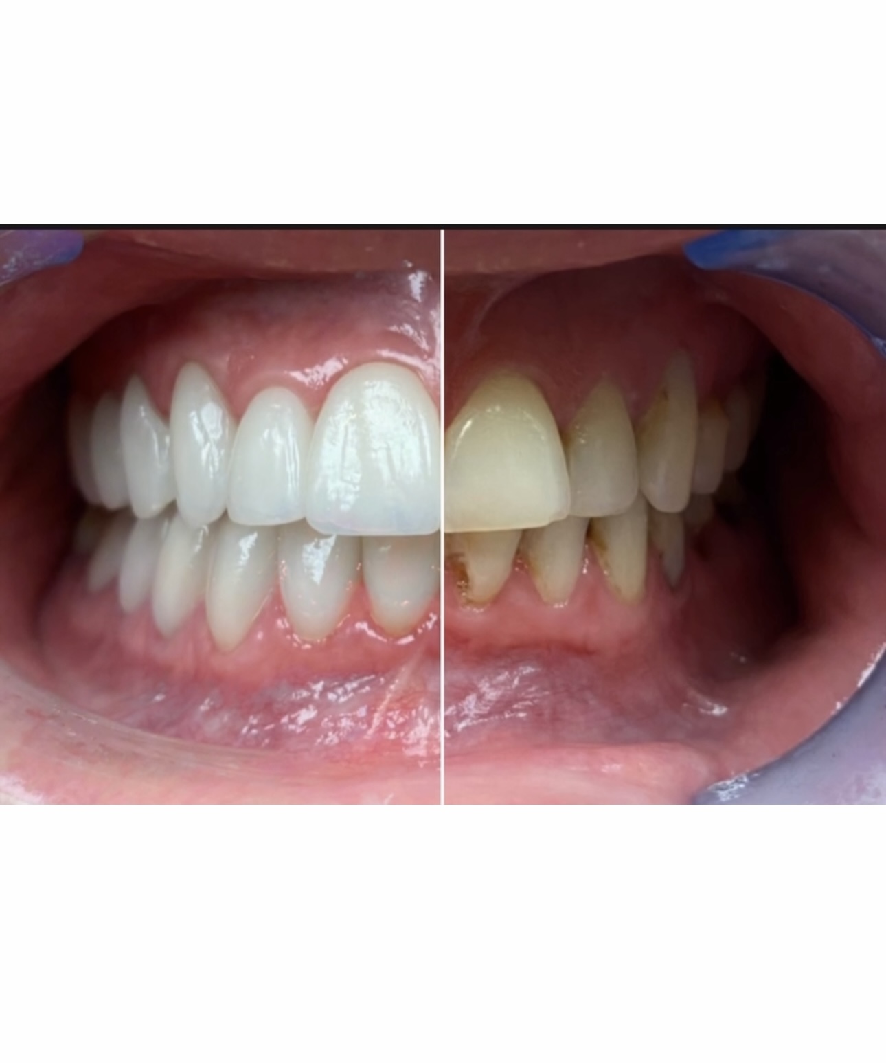 Before and After Image: Smile Makeover - front