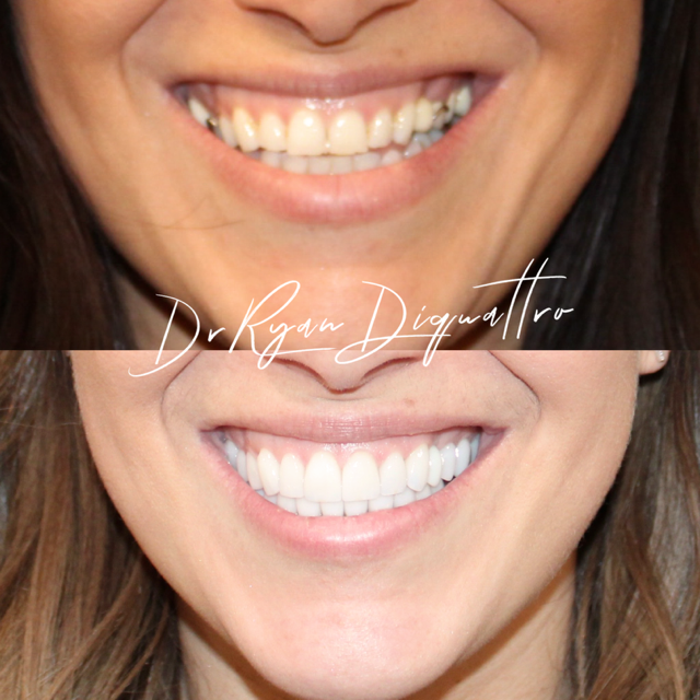 Before and After Image: Smile Makeover - front